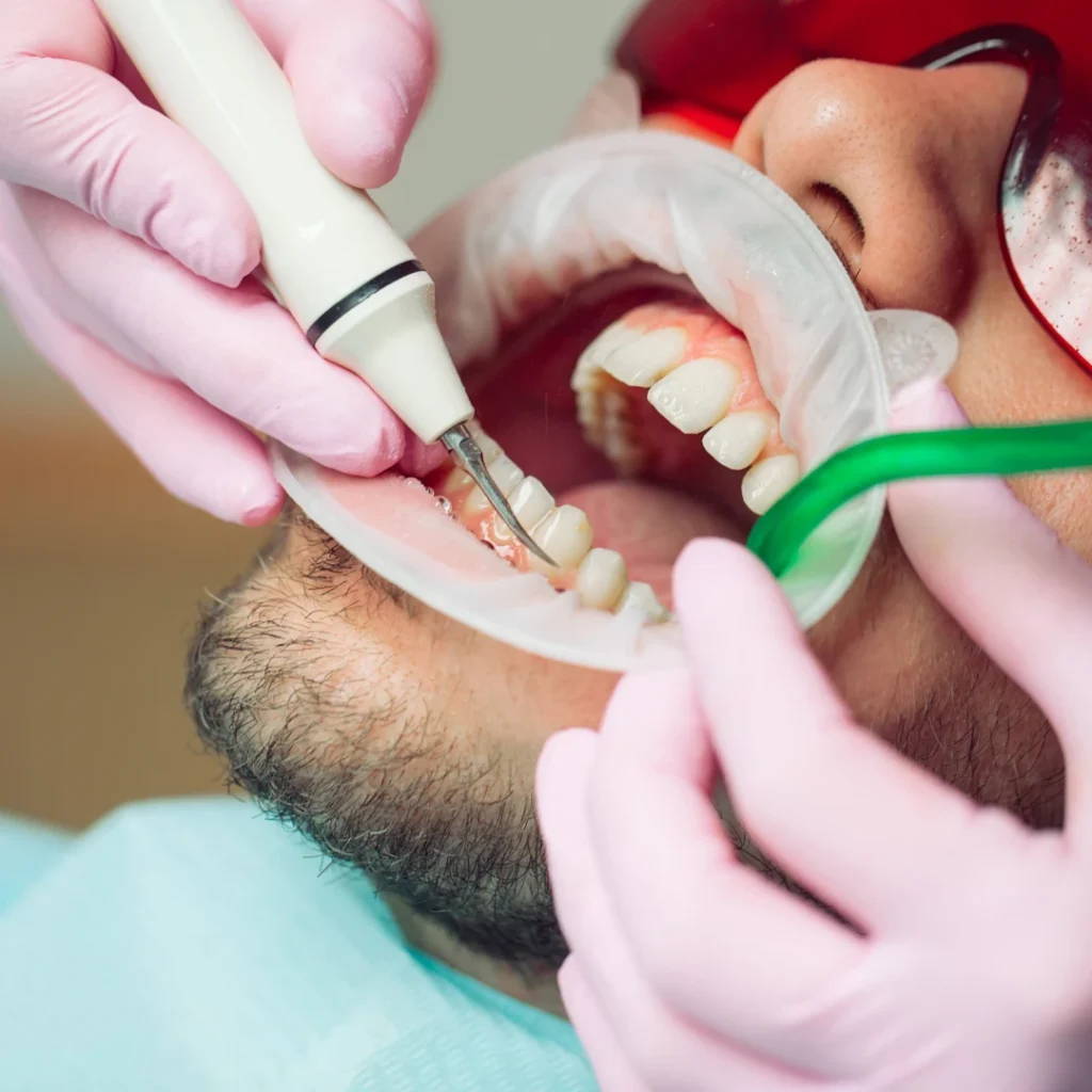 What Happens During a Teeth Cleaning