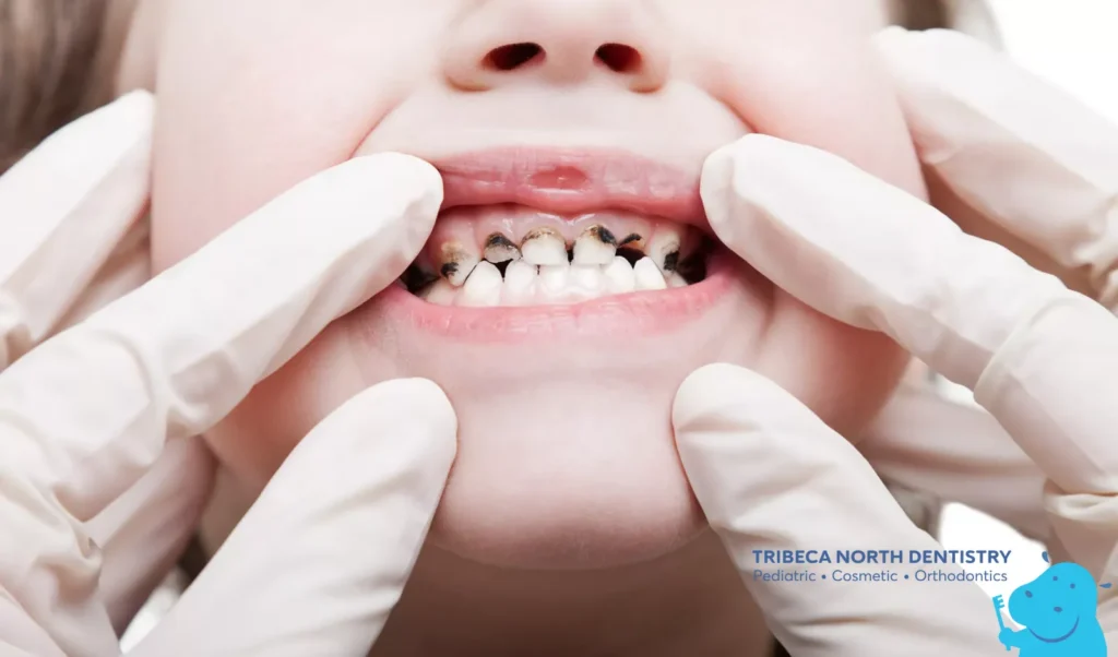 Which Children Benefit Most from Sealants