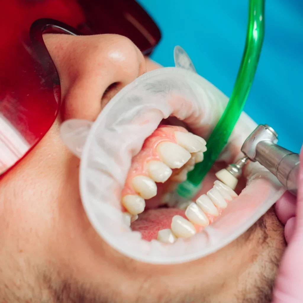 Why Teeth Cleaning Is Important