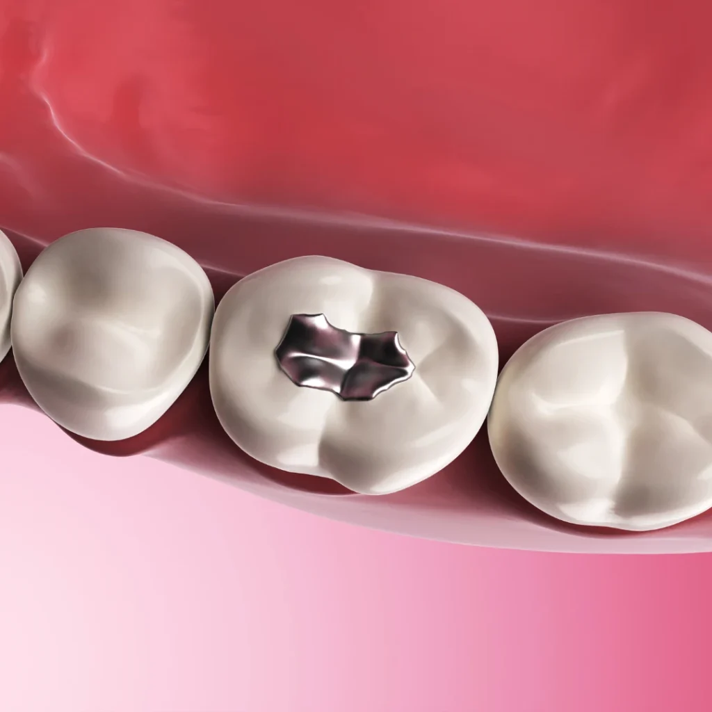 Comparing Tooth Colored Fillings to Metal Fillings