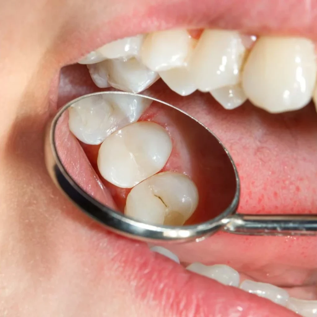 How Long Do Dental Sealants Last