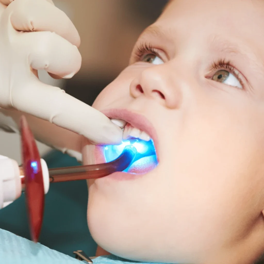 Protecting Children’s Teeth with Dental Sealants
