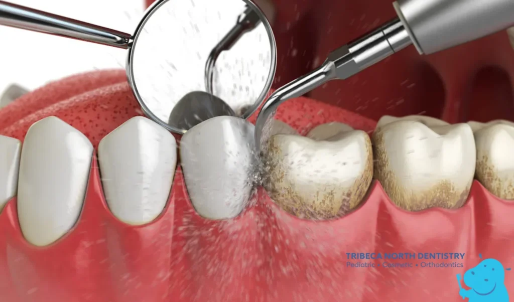 Step 1 Cleaning the Teeth