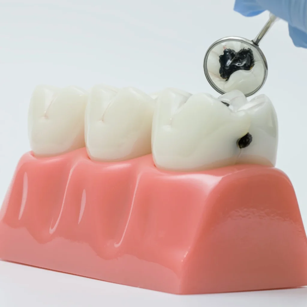 When This Type of Filling Is Recommended