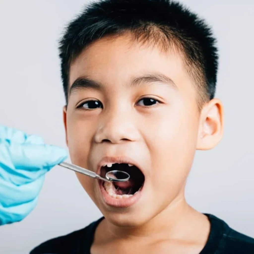 Who Should Get Dental Sealants