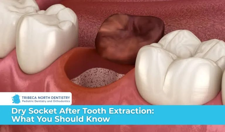 Dry Socket After Tooth Extraction What You Should Know
